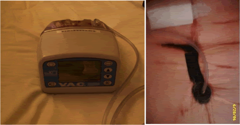 Wound Vac